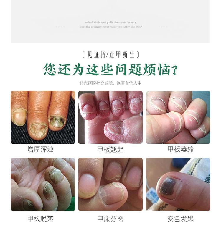 灰指甲抗菌液(圖3) 灰指甲液oem貼牌產(chǎn)品