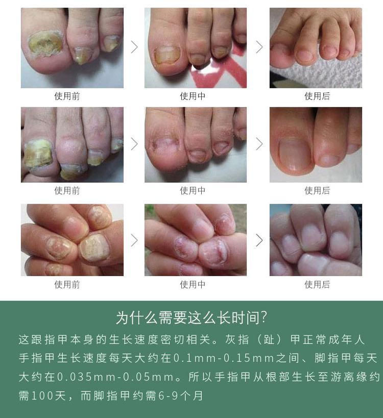 灰指甲抗菌液(圖11) 灰指甲液oem貼牌產(chǎn)品